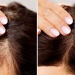 Understanding Hair Loss Treatment