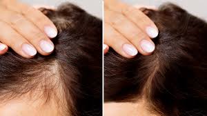 Understanding Hair Loss Treatment